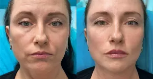 Fullface: Medycyna Estetyczna w Służbie Naturalnego Piękna
