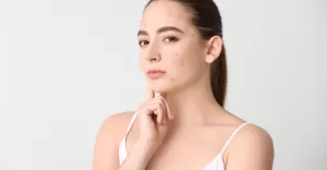 wpływ hormonów na cerę