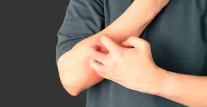 Atopowe zapalenie skóry